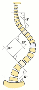 Messung des Cobb-Winkels (89 Grad) bei einer Skoliose
