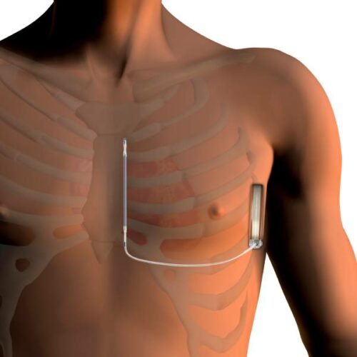 Subkutaner intrakardialer Defibrillator (S-ICD): Die bessere ICD-Alternative für Sportler mit Arrhythmierisiko?