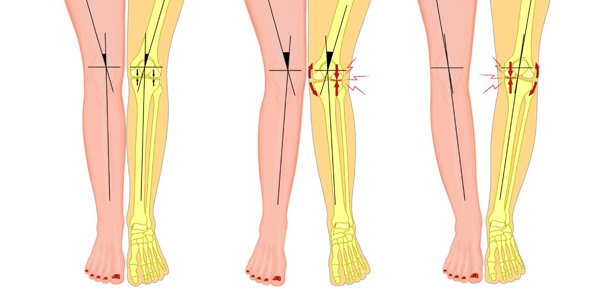 O-Beine, X-Beine und Arthroserisiko