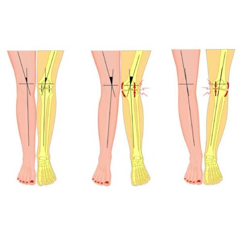 O-Beine, X-Beine und Arthroserisiko